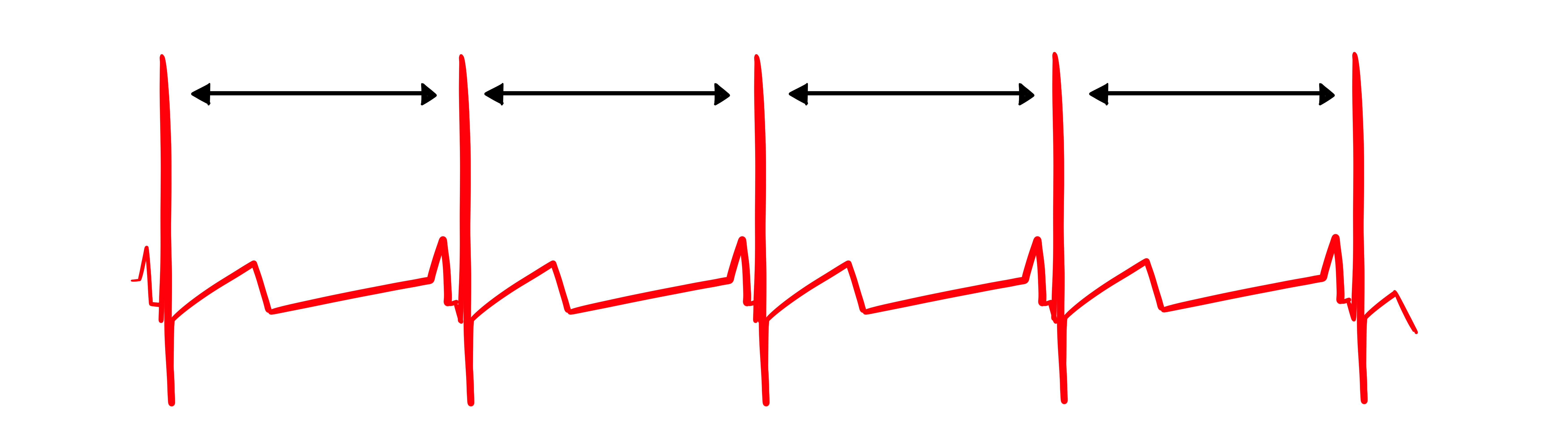 Record showing no heart rate variability with identical interbeat intervals